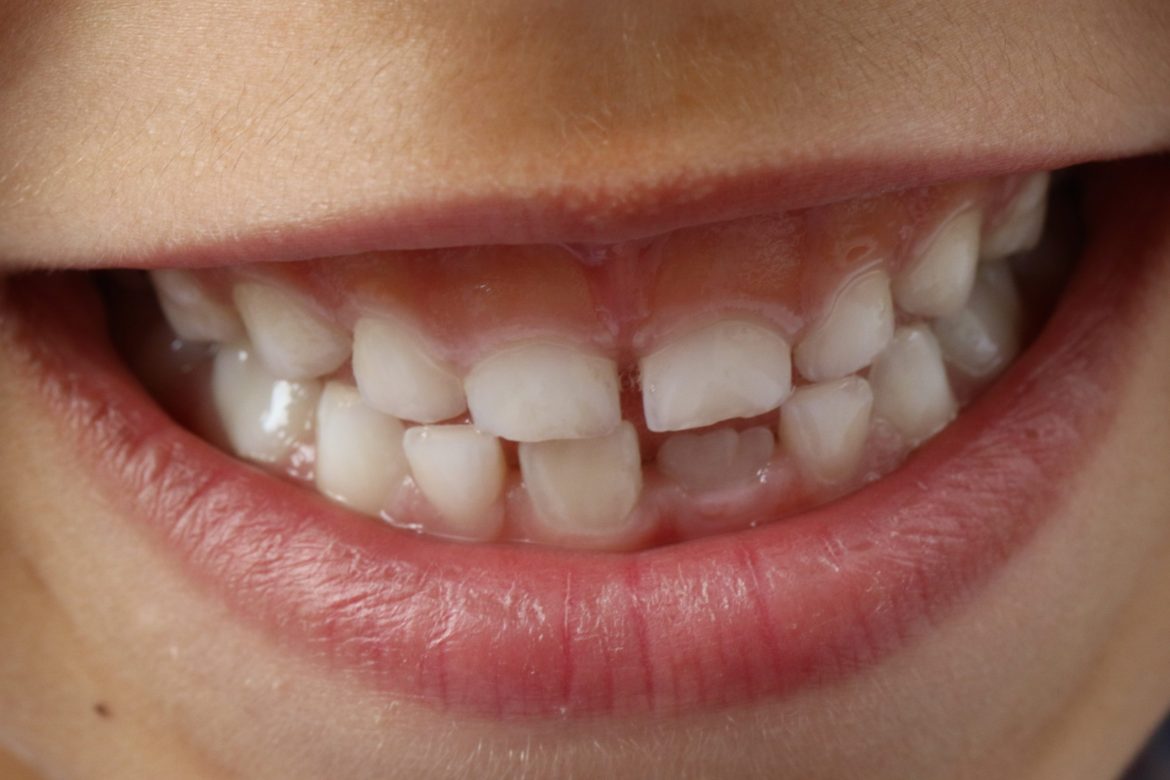 De ce apare înghesuirea dentară